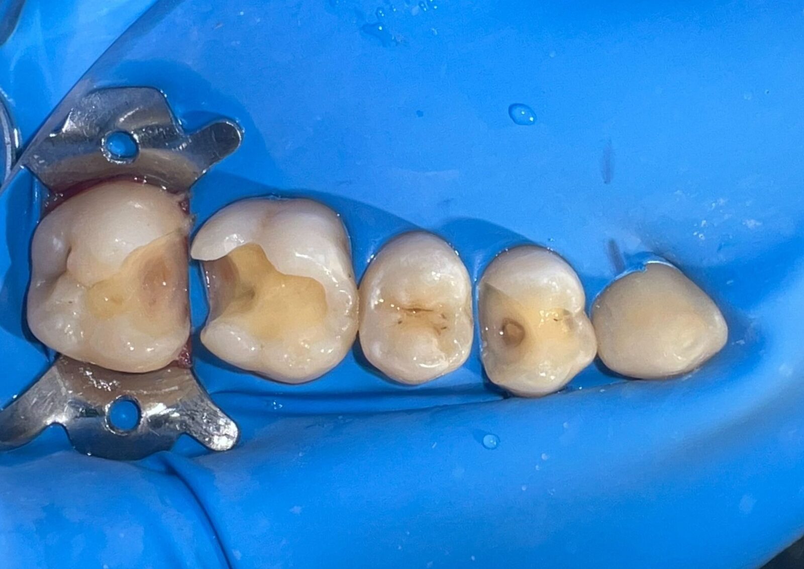 Fotokompozitní výplně – snímek v průběhu ošetření