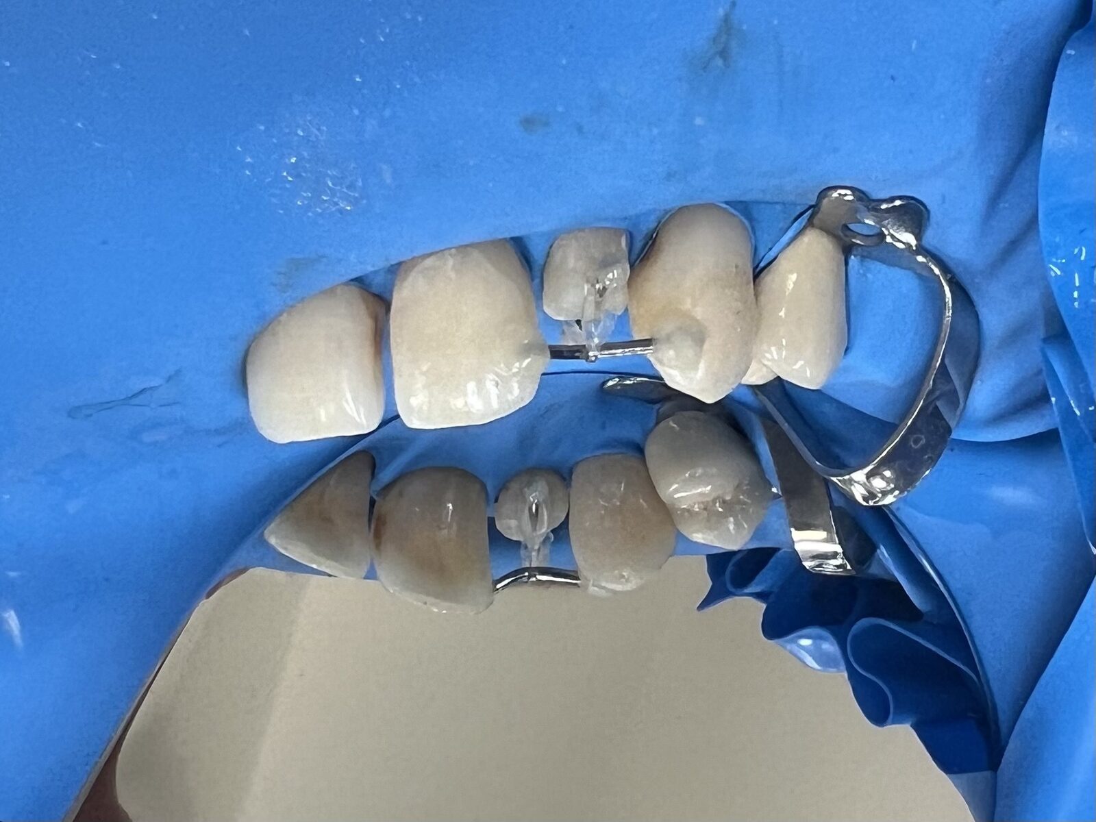 Kompozitní výplně a dostavby, ortodontická extruze „nesanovatelného“ zubu – snímek v průběhu ošetření