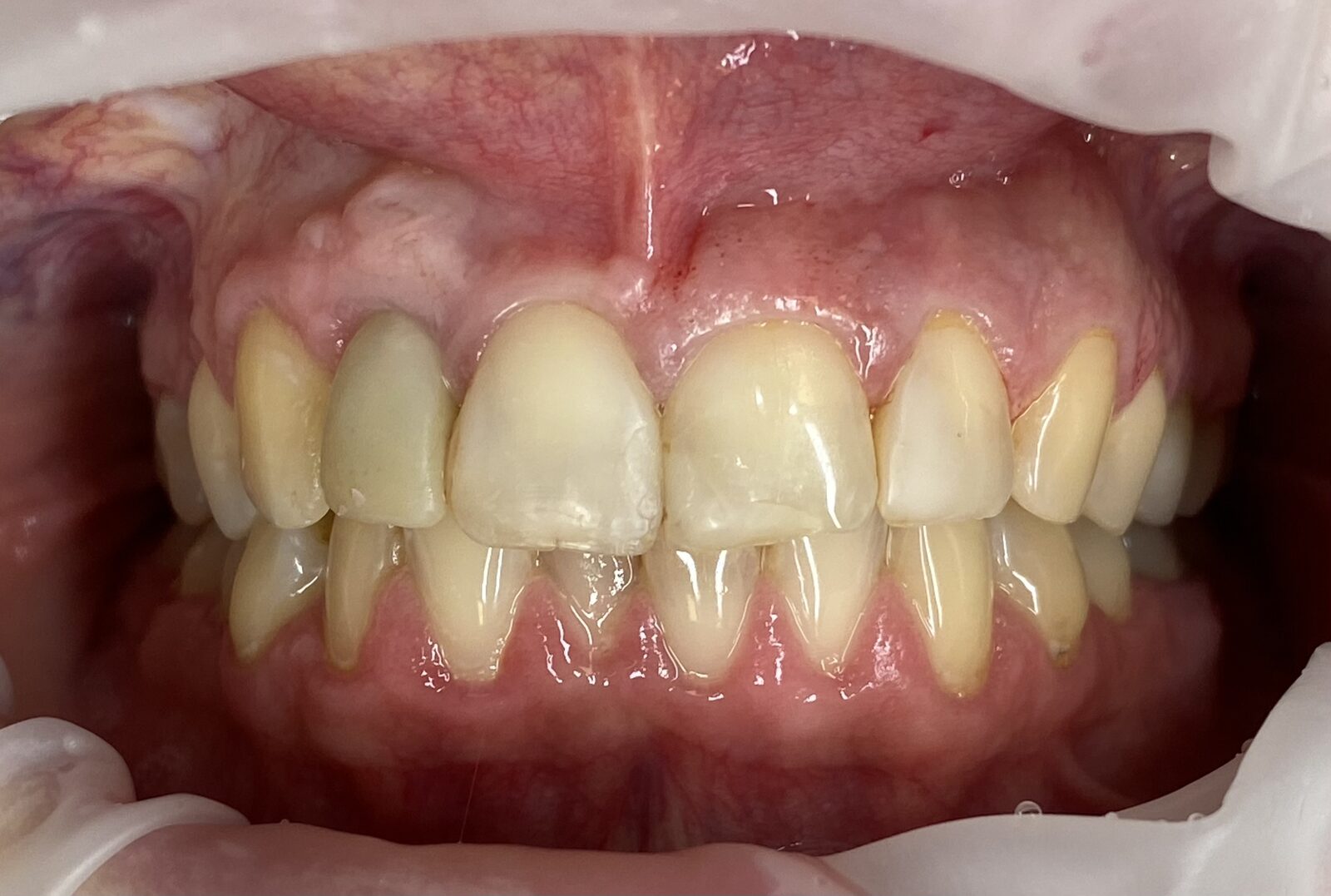 Estetická rekonstrukce předních řezáků – náhrada dvojky implantátem, keramické fazety – snímek před ošetřením