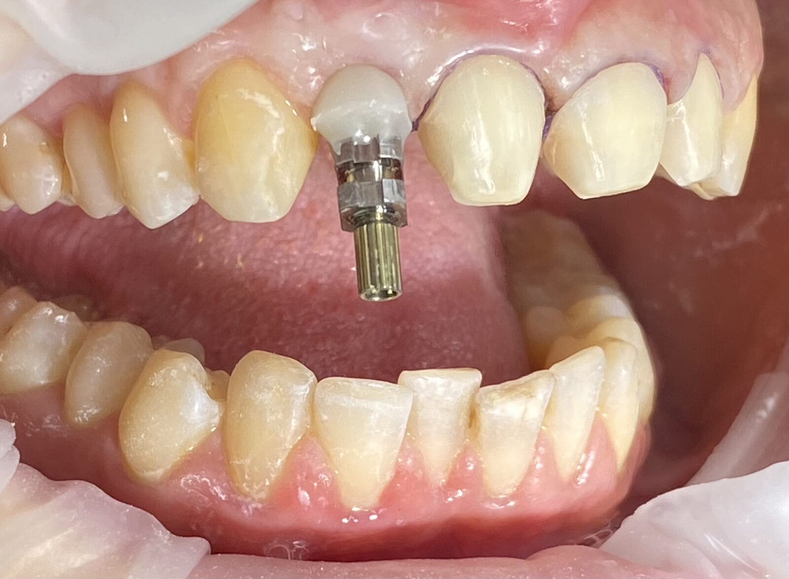 Estetická rekonstrukce předních řezáků – náhrada dvojky implantátem, keramické fazety – snímek v průběhu ošetření